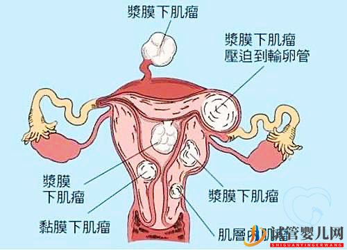 多發性子宮肌瘤可以做試管嬰兒嗎?你都了解嗎(圖1) 多發性子宮肌瘤可以做試管嬰兒嗎?你都了解嗎(圖1)