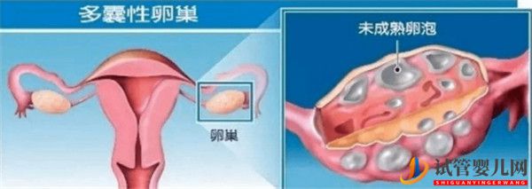 多囊卵巢綜合征對試管嬰兒成功率有哪些影響_如何及時調(diào)理(圖1)