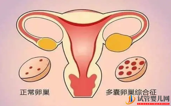 雙側卵巢多囊能懷孕嗎 雙側卵巢多囊原因是什么(圖2)
