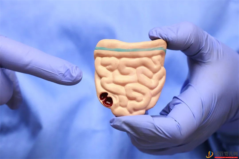 結(jié)直腸癌發(fā)病年輕化，如何篩查？(圖1)