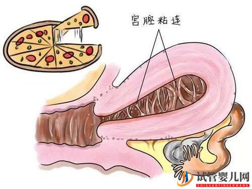 子宮粘連可以做試管嬰兒嗎？成功率高不高？(圖1)