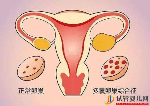 試管取卵后怎么解決卵巢過(guò)度刺激綜合癥(圖1)