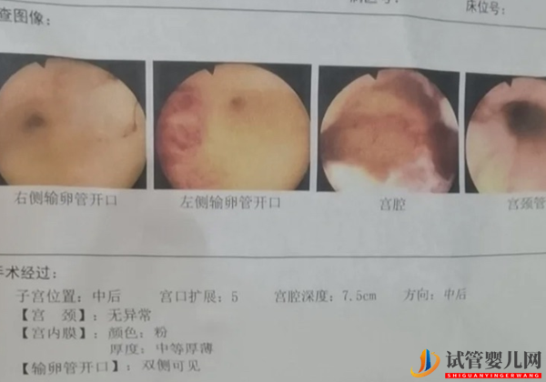 做試管為什么要做宮腔鏡檢?(圖2)