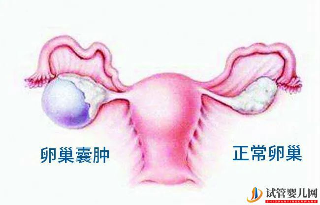 有卵巢囊腫可以做試管嬰兒嗎？(圖1)
