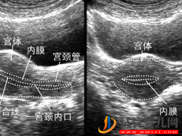 薄型子宮內(nèi)膜臨床表現(xiàn)和診斷標準匯總，及時發(fā)現(xiàn)避免不孕(圖1)