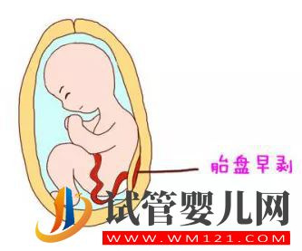 胎盤早剝是什么原因引起的？(圖1)