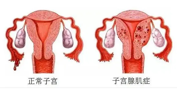 子宮腺肌癥能去跟嗎？有效的治療方案大全(圖1)