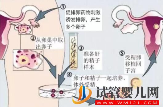 人工授精多次失敗后還可以做試管嬰兒嗎?(圖2) 人工授精多次失敗后還可以做試管嬰兒嗎?(圖2)