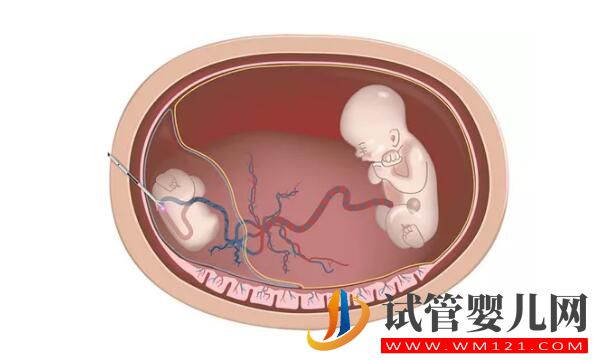 試管嬰兒減胎術在哪些情況下使用 要注意哪些(圖1)