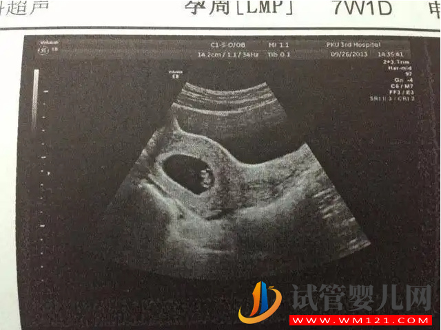 b超監測有卵黃囊基本是宮內妊娠，不管出現早晚都穩了(圖2)