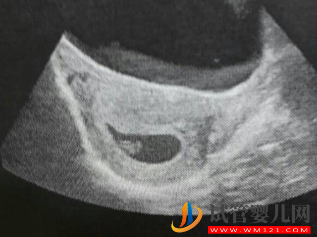 b超監測有卵黃囊基本是宮內妊娠，不管出現早晚都穩了(圖3)