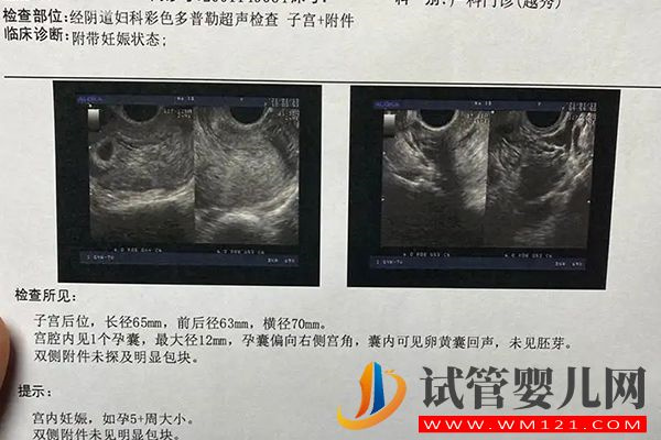 自貢檢查卵泡做b超還是陰超視情況而定，但這3點(diǎn)區(qū)別要知曉(圖3)