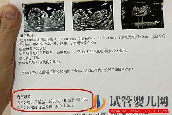 nt值是否一樣不是判斷龍鳳胎標準，這些看雙胎方法可了解(圖2)