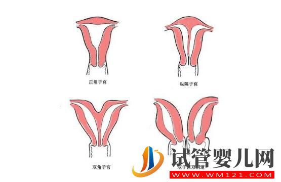 子宮偏小的女性做試管嬰兒嗎?來看看吧(圖1) 子宮偏小的女性做試管嬰兒嗎?來看看吧(圖1)