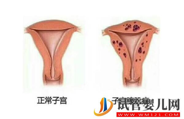 子宮腺肌癥能做試管嬰兒嗎?應(yīng)該如何備孕(圖1) 子宮腺肌癥能做試管嬰兒嗎?應(yīng)該如何備孕(圖1)