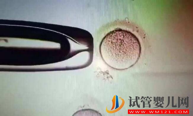 子宮腺肌癥能做試管嬰兒嗎?應(yīng)該如何備孕(圖4) 子宮腺肌癥能做試管嬰兒嗎?應(yīng)該如何備孕(圖4)