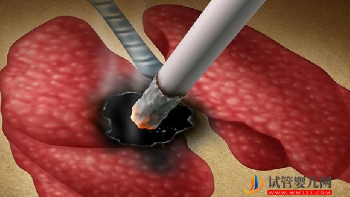 肺癌患者可以過性生活嗎？你知道為什么肺癌不傳染嗎？(圖2)