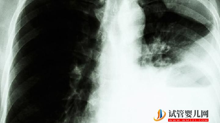 肺癌患者可以過性生活嗎？你知道為什么肺癌不傳染嗎？(圖1)