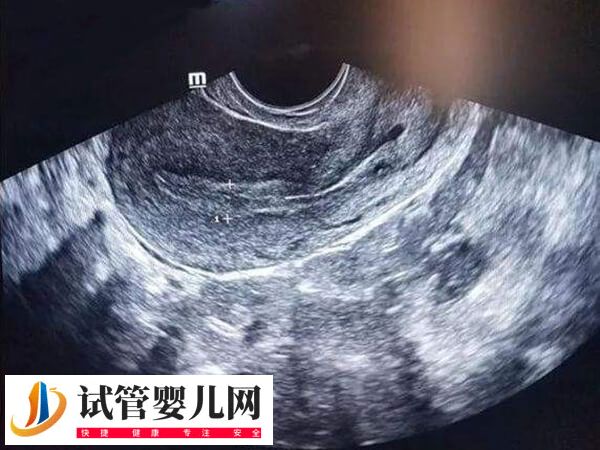 子宮切除手術(shù)有哪5種